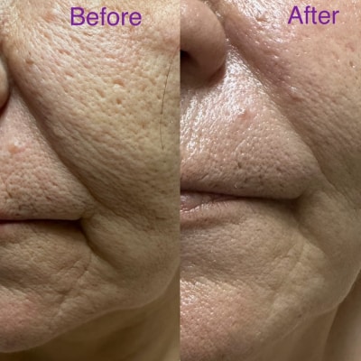 ANTI-AGING FACIAL